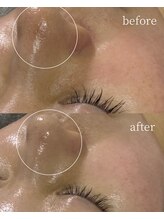 サロンナナジュウニ(Salon72)/毛穴黒ずみ/赤み