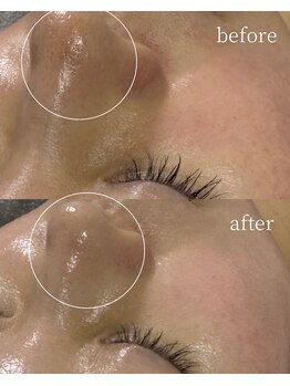 サロンナナジュウニ(Salon72)/毛穴黒ずみ/赤み