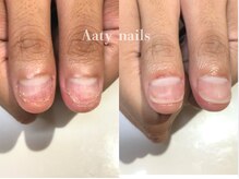アーティネイルズ(Aaty Nails)/【深爪矯正】ハンド