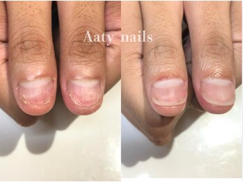 【深爪矯正】ハンド