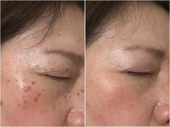 マハロ(mahalo)の写真/炭酸ガスパックで透明感やハリツヤを実感し、様々な肌トラブルを改善!是非一度お試しください♪