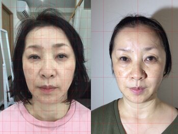 整体サロン プラスエル 東向島(Plus L)/小顔★ビフォーアフター