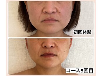 アンドモア(&more)/小顔症例