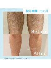 メンズクリア 高知帯屋町店/【メンズクリア】お客様の施術例