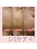 【シミケア祭】シミケア10分当て放題+ヘッドスパ10分+美肌パック付￥7,100→
