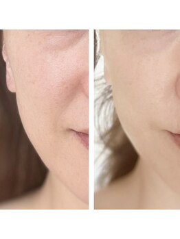 アドビューティ(Add Beauty)/≪たるみ改善／RFリフティング≫