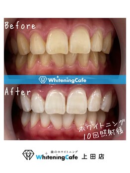 ホワイトニングカフェ 上田店/ホワイトニングビフォーアフター