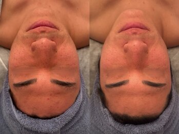 ポーデベロア(Peau des velours)/陶肌トリートメント/男性