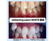 ホワイトニングサロン ホワイト(WHITE)/セルフホワイトニング/大阪/福島