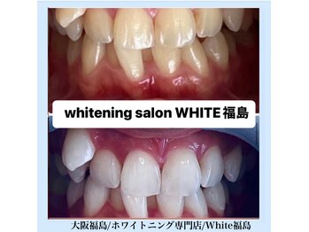 ホワイトニングサロン ホワイト(WHITE)/セルフホワイトニング/大阪/福島
