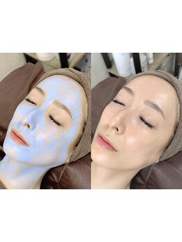 美白ケアをしたい