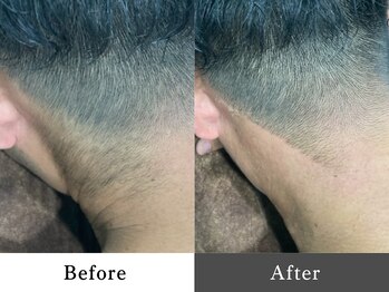 メンズオージー 岡山中区(men's O.G)/メンズ脱毛｜襟足脱毛