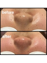 クリアボックス(Clear box)/【本気の毛穴洗浄】