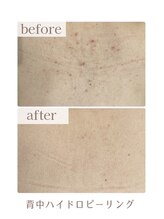 アリュール(ALLURE)/背中ハイドロピーリング施術効果