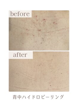 アリュール(ALLURE)/背中ハイドロピーリング施術効果