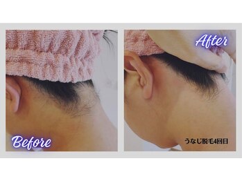 リボーン(Re bone)/全身脱毛がお得♪　