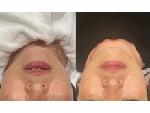 トトノエル(TOTONOEL)/高濃度炭酸導入＋ピーリング