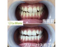 ルブラン 奈良店(Le Blanc)/黄ばみは自然には取れない！