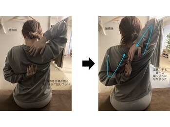 ツリーオブボディケア(TREE OF BODY CARE)/巻き肩・いかり肩・結帯動作改善