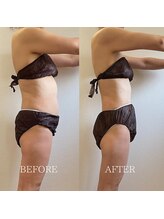 ブルーム(BLOOM)/痩身プログラム＋エレクトロ6回