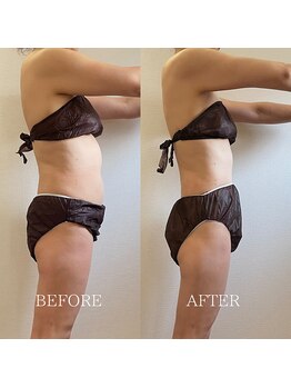 ブルーム(BLOOM)/痩身プログラム＋エレクトロ6回