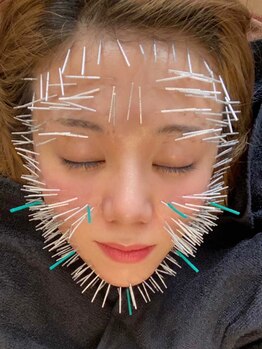 プレシャスワン 越谷店の写真/【速効で実感！美容鍼】☆大人女性のたるみ・ほうれい線のお悩み改善！キュッとリフトUP！