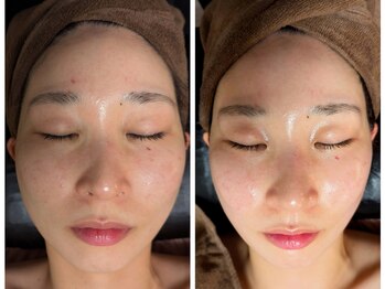 ラグーン(Lagoon)/WINBACK×小顔矯正