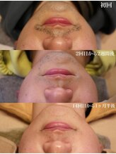 ベビースキン(baby skin)/髭脱毛