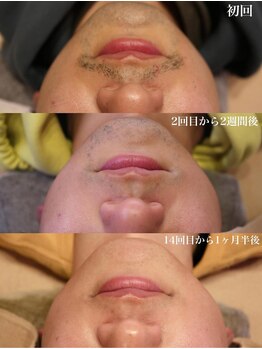 ベビースキン(baby skin)/髭脱毛