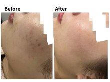 ムーロ バイ ミュー(muro. by mieux)/ハーブピーリングBeforeAfter