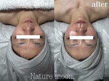 ナチュールムーン(Nature moon.)/ハーブピーリング