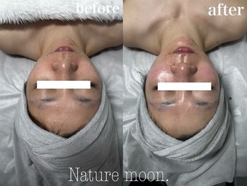 ナチュールムーン(Nature moon.)/ハーブピーリング