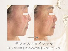 アネラボーテ(Anela Beaute)/ラフォスフェイシャル1回目