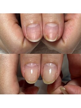 セラキュアネイル(Theracure nail)/傷んだ爪も自爪育成