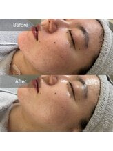 凰湖/毛穴・赤み・ゴワツキ※施術1回