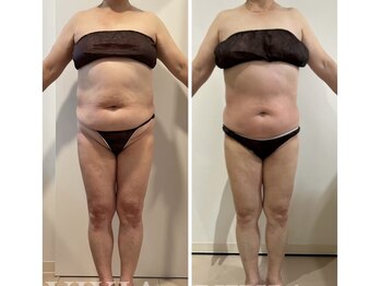 ヴィクシア(VIXIA)/痩身90分