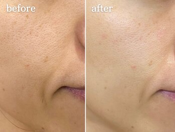 メルシア(merucia)/毛穴、開き、トーンUP