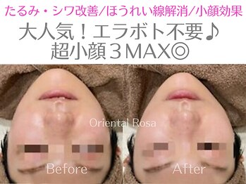 オリエンタルローザ 表参道(Oriental Rosa)/超小顔3MAX！！エラボト不要！