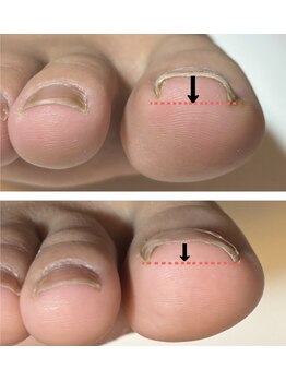 爪の悩みを解消できる（ケア含む）
