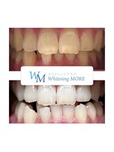 ホワイトニング モア(Whitening MORE)/ビフォーアフター