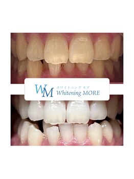 ホワイトニング モア(Whitening MORE)/ビフォーアフター