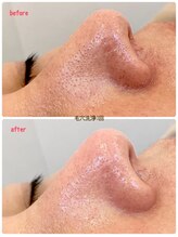 ミレボ(Me.rebo)/毛穴洗浄before→after