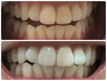 カシワビューティーココ(kashiwa beauty coco)/ホワイトニング