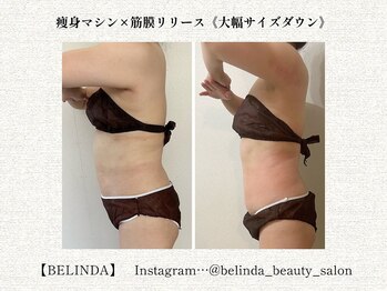 ベリンダ 中崎町店(BELINDA)/【痩身マシン×筋膜リリース】
