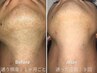 当店人気No.2【メンズ脱毛】「頬・口下・鼻下・鼻・額・前首」ヒゲ脱毛　