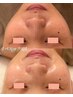 夏に向けて自発光!!メイク直しのいらない肌へ【リベルック】症例モニター
