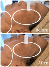 リュミエール デスポワール(Lumiere d'espoir)/ハーブピーリング