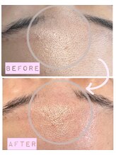 ツリービューティー(Tree Beauty)/★毛穴の汚れ気になりませんか★