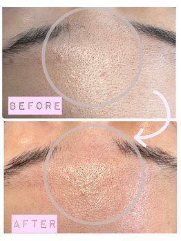 ツリービューティー(Tree Beauty)/★毛穴の汚れ気になりませんか★