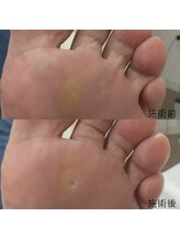 なかやまネイルクリニック/魚の目